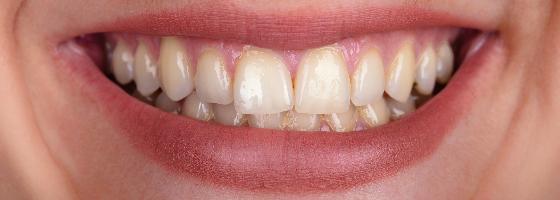 Beljenje zuba je jedan od najpopularnijih i najneinvazivnijih načina za ulepšavanje Vašeg osmeha.