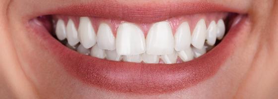 Beljenje zuba je jedan od najpopularnijih i najneinvazivnijih načina za ulepšavanje Vašeg osmeha.