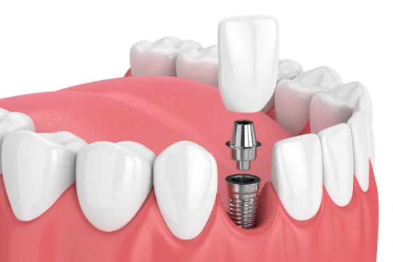Implantologija je danas jedna od najpopularnijih oblasti stomatologije. Implantati su biokompatibilni zamenici korena zuba koji se ugrađuju u kost.