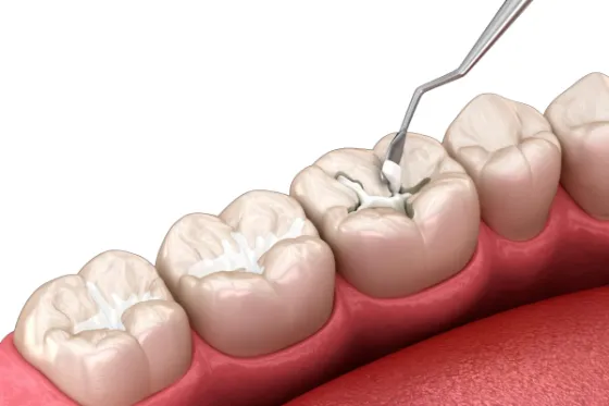 Plombe predstavljaju stomatološke materijale kojima nadoknađujemo izgubljeni deo zuba, bilo da je uzročnik karijes ili nešto drugo što je dovelo do njegovog oštećenja.